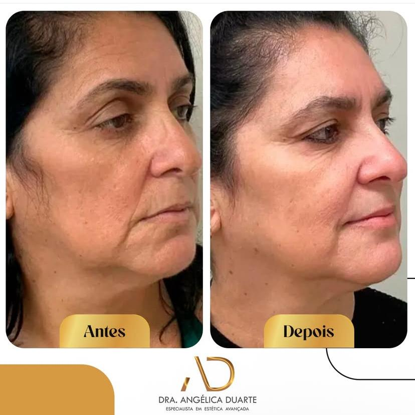 Antes e depois 1