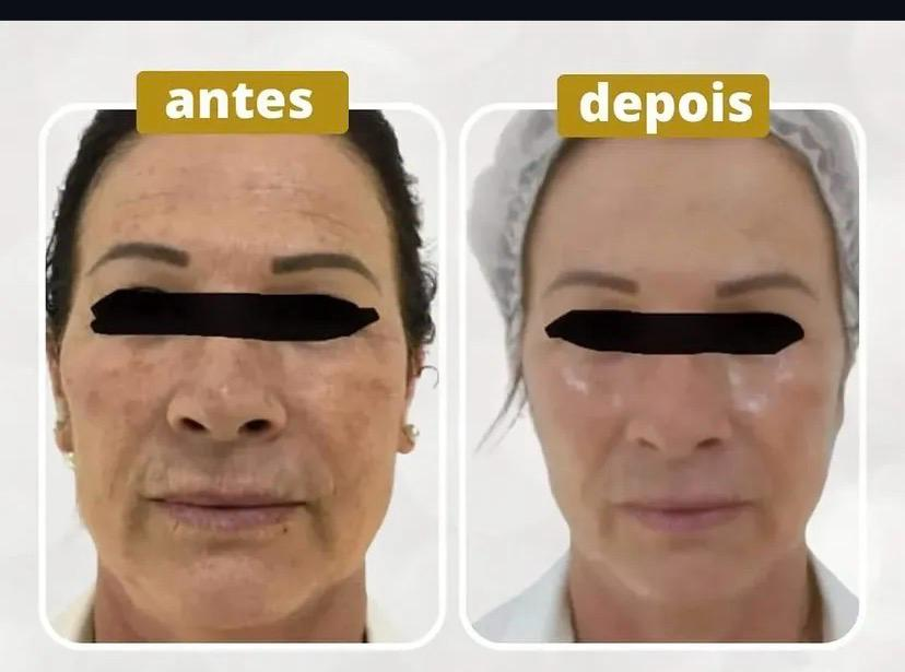 Antes e depois 2